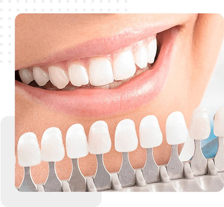 Porcelain Veneers checking right color