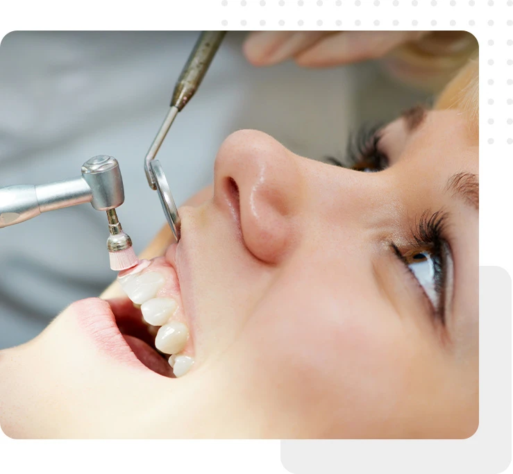 Opalescense Teeth Whitening