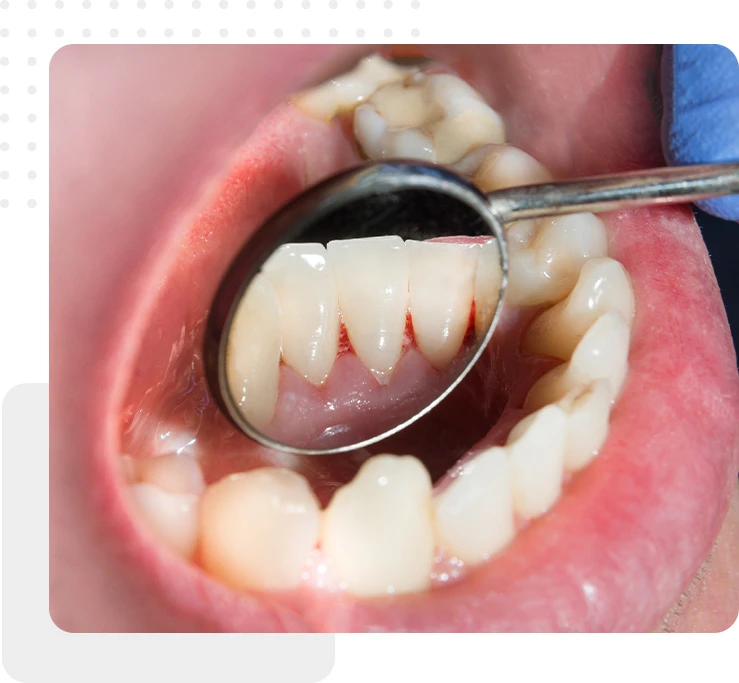 periodontal Scaling Root Planing clean
