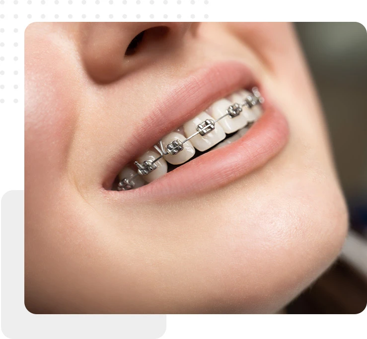 Orthodonthic Treatment Braces closeup