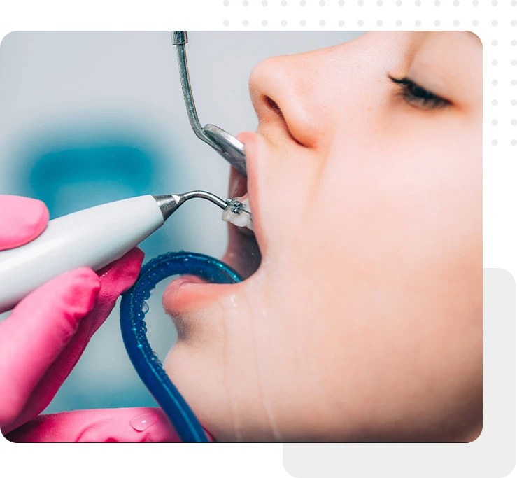 Orthodontic Treatment Braces cleaning