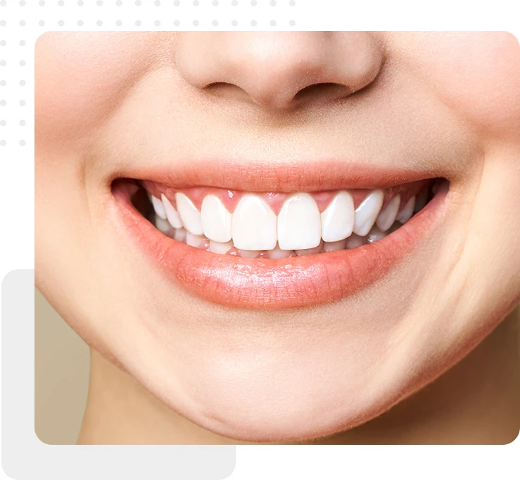 Teeth Whitening smile