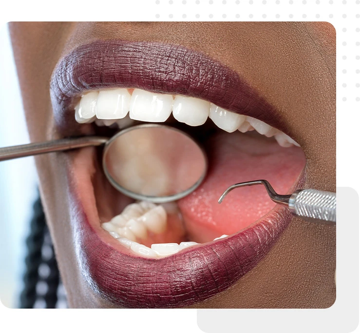 periodontal Scaling Root Planing