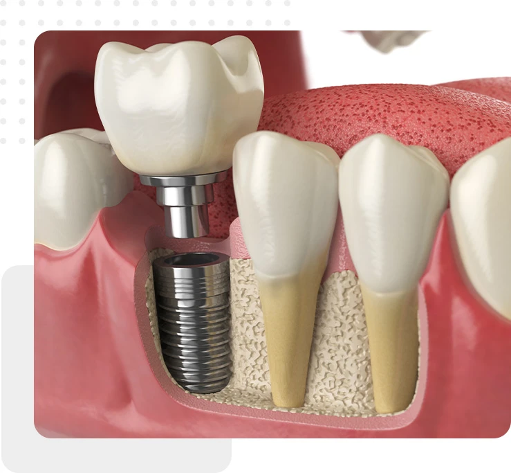 dental implants